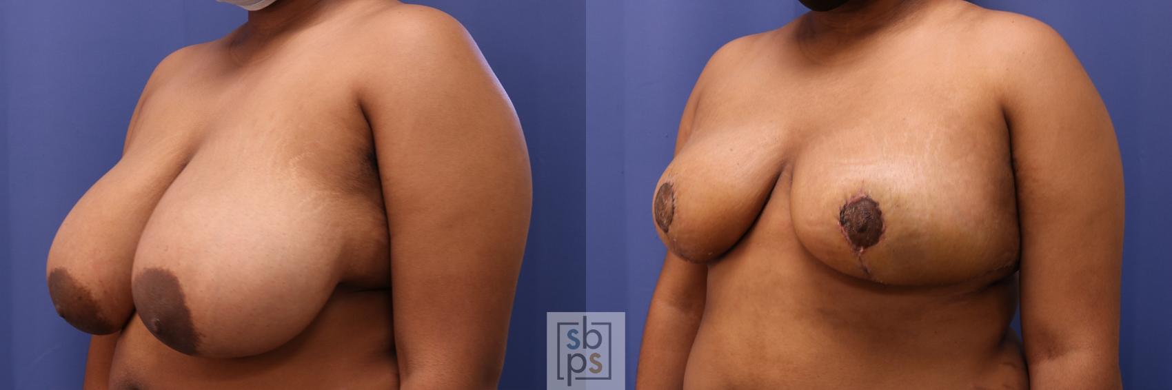 Before & After Breast Reduction Case 467 Left Oblique View in Los Angeles, Torrance & Long Beach, CA