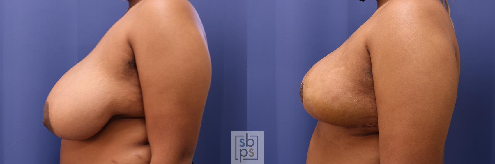 Before & After Breast Reduction Case 467 Left Side View in Los Angeles, Torrance & Long Beach, CA