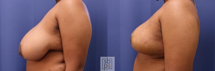 Before & After Breast Reduction Case 467 Left Side View in Torrance, CA