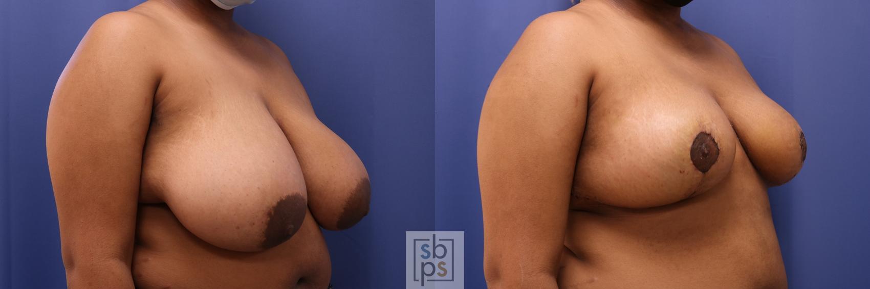 Before & After Breast Reduction Case 467 Right Oblique View in Los Angeles, Torrance & Long Beach, CA