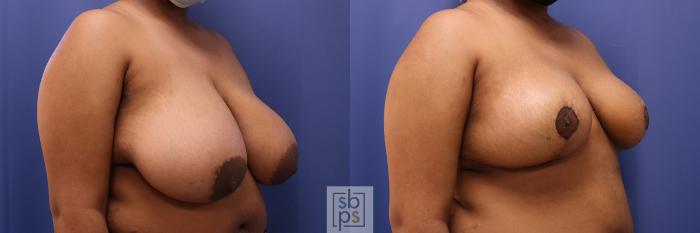 Before & After Breast Reduction Case 467 Right Oblique View in Torrance, CA