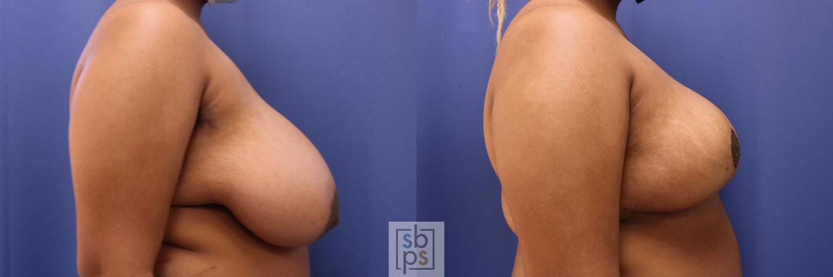 Before & After Breast Reduction Case 467 Right Side View in Los Angeles, Torrance & Long Beach, CA