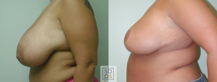 Before & After Breast Reduction Case 48 View #2 View in Torrance, CA