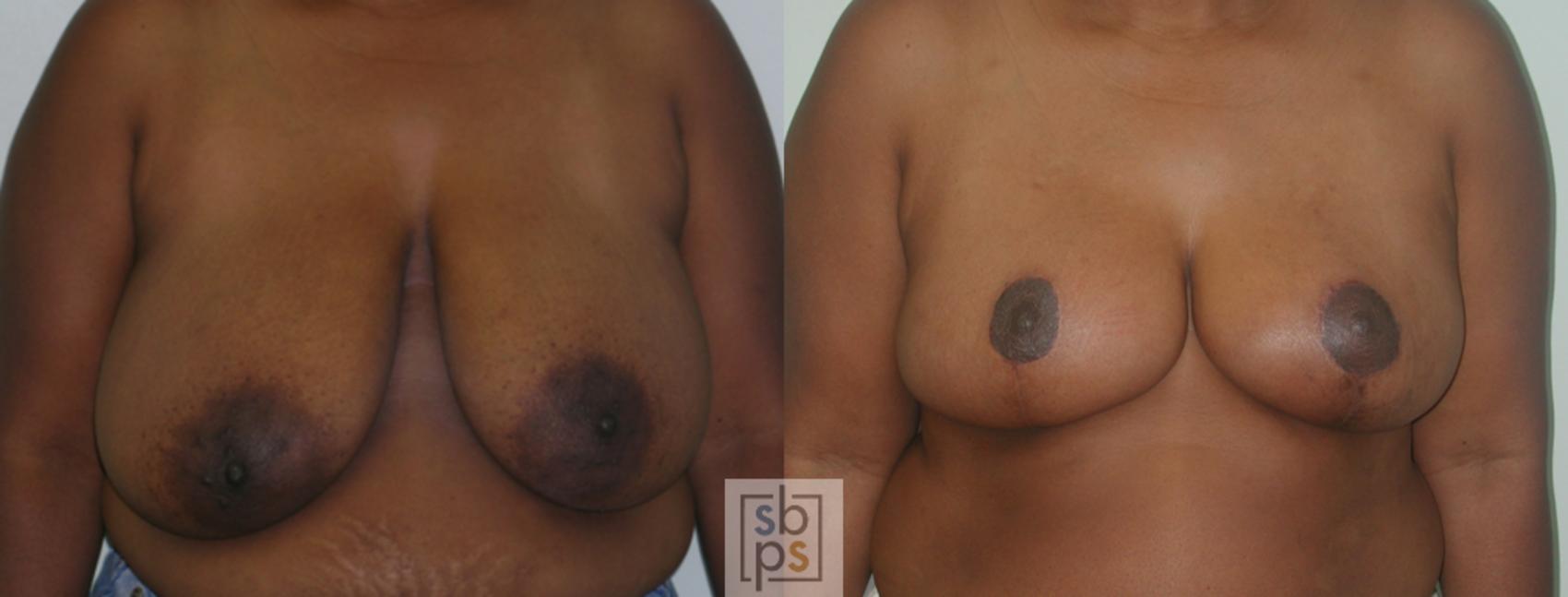 Before & After Breast Reduction Case 49 View #1 View in Torrance, CA