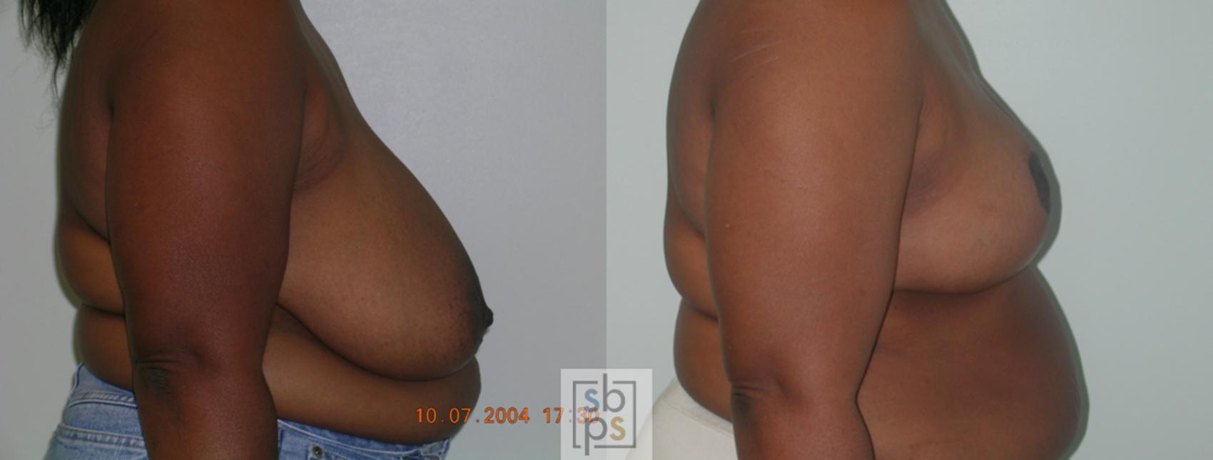 Before & After Breast Reduction Case 49 View #2 View in Torrance & Los Angeles, CA, CA