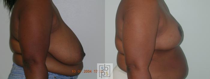 Before & After Breast Reduction Case 49 View #2 View in Torrance, CA