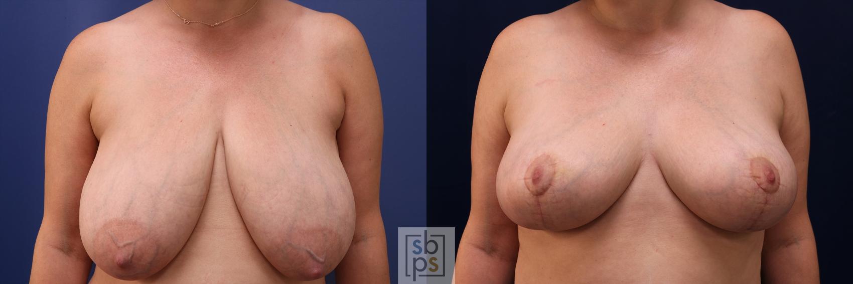 Before & After Breast Reduction Case 491 Front View in Torrance, CA