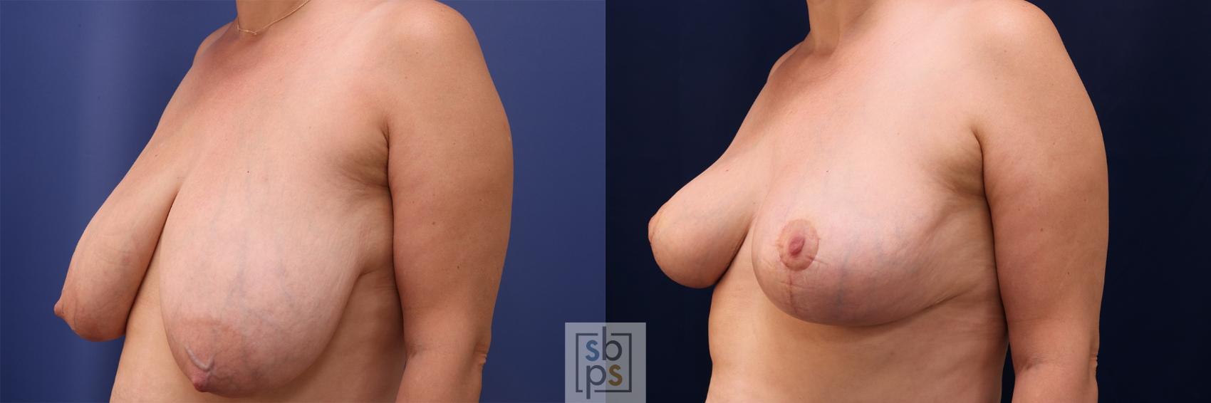 Before & After Breast Reduction Case 491 Left Oblique View in Torrance & Los Angeles, CA, CA