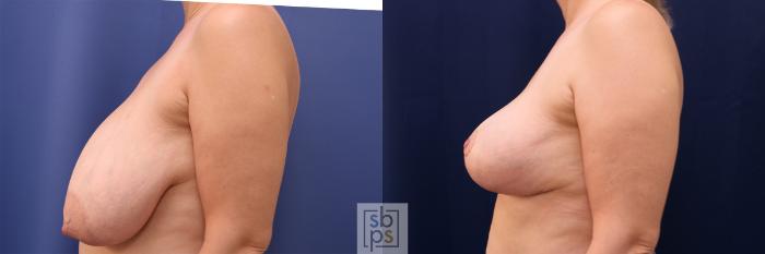 Before & After Breast Reduction Case 491 Left Side View in Torrance, CA