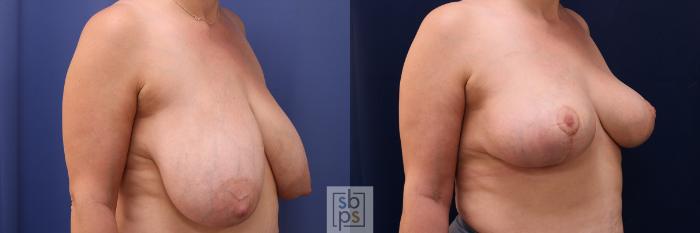 Before & After Breast Reduction Case 491 Right Oblique View in Torrance, CA