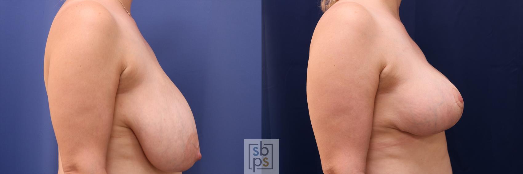 Before & After Breast Reduction Case 491 Right Side View in Torrance & Los Angeles, CA, CA