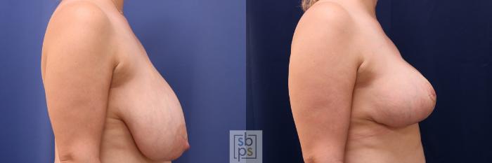 Before & After Breast Reduction Case 491 Right Side View in Torrance, CA