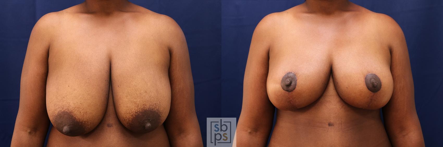 Before & After Breast Reduction Case 496 Front View in Torrance, CA