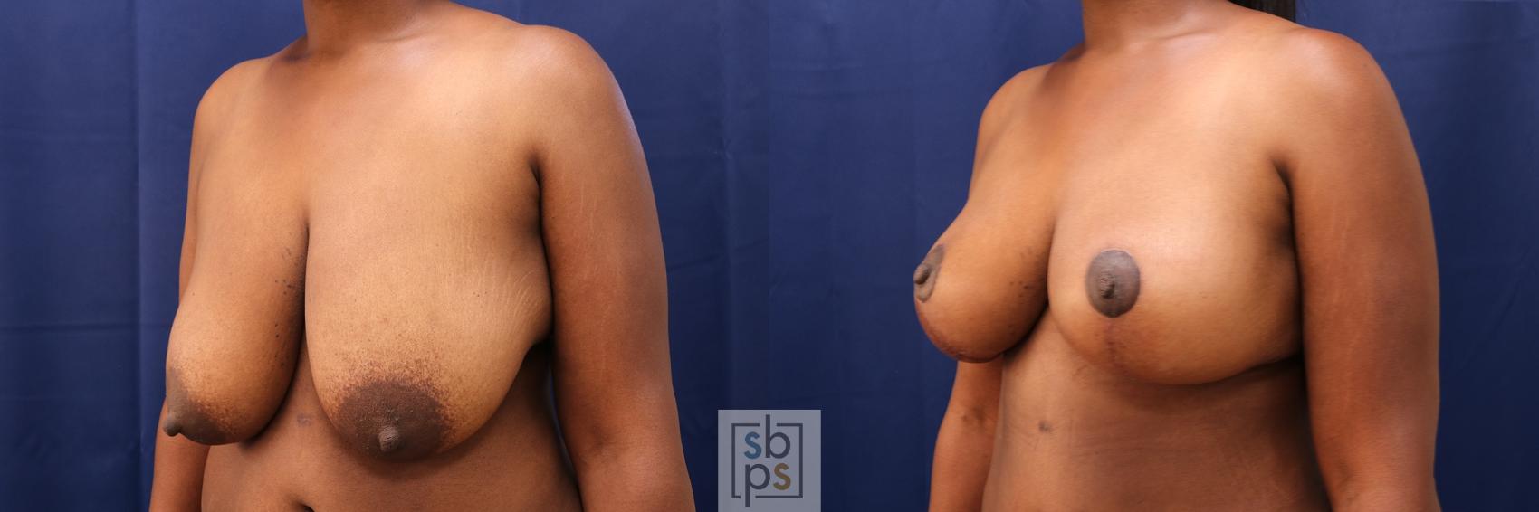 Before & After Breast Reduction Case 496 Left Oblique View in Torrance & Los Angeles, CA, CA