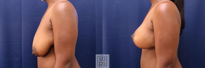 Before & After Breast Reduction Case 496 Left Side View in Torrance, CA