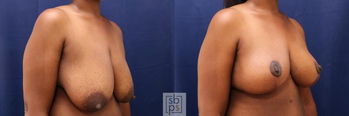 Before & After Breast Reduction Case 496 Right Oblique View in Torrance, CA