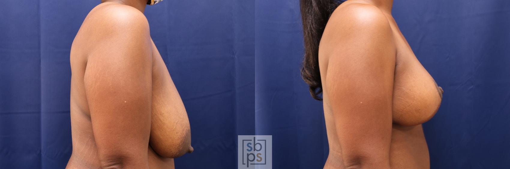 Before & After Breast Reduction Case 496 Right Side View in Torrance & Los Angeles, CA, CA