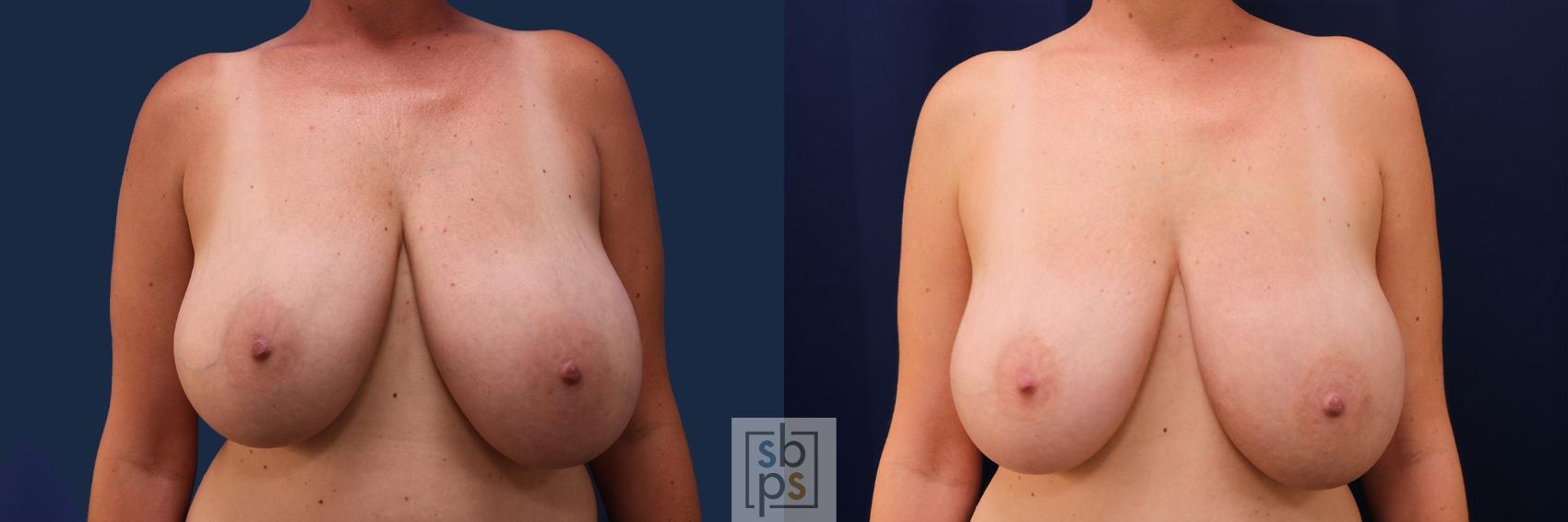 Before & After Breast Reduction Case 499 Front View in Torrance, CA