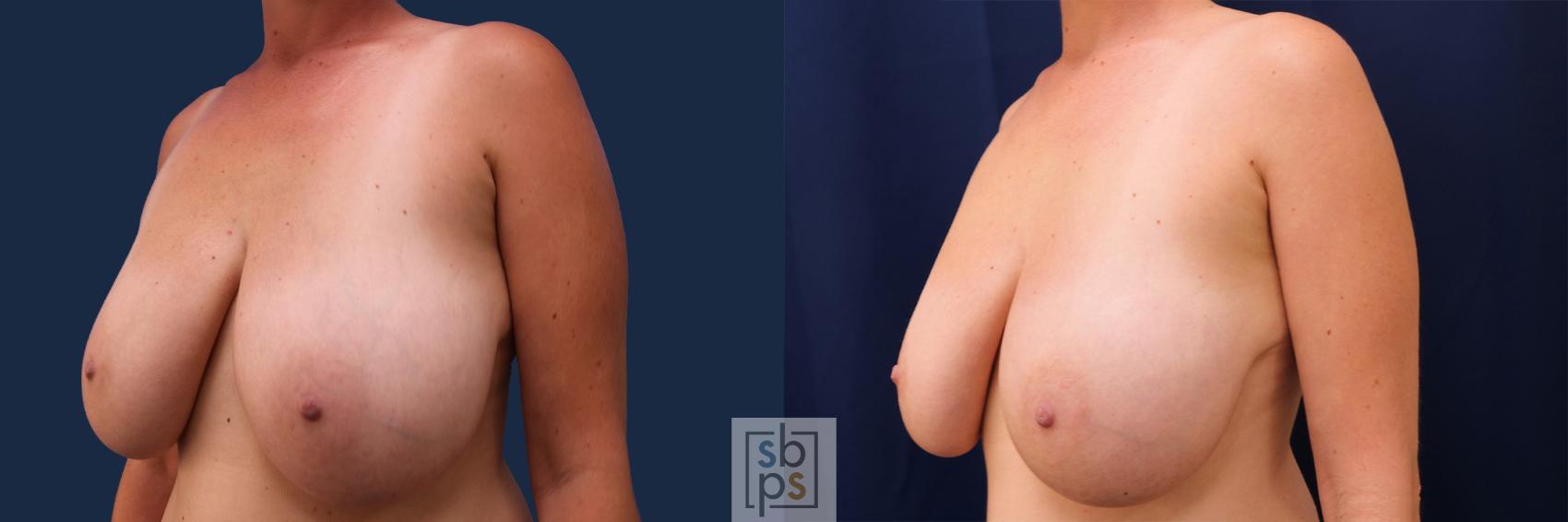 Before & After Breast Reduction Case 499 Left Oblique View in Torrance & Los Angeles, CA, CA