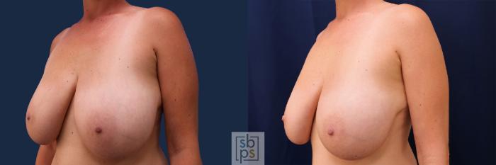 Before & After Breast Reduction Case 499 Left Oblique View in Torrance, CA