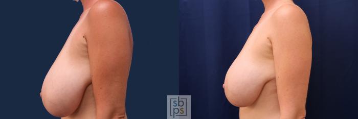 Before & After Breast Reduction Case 499 Left Side View in Torrance, CA