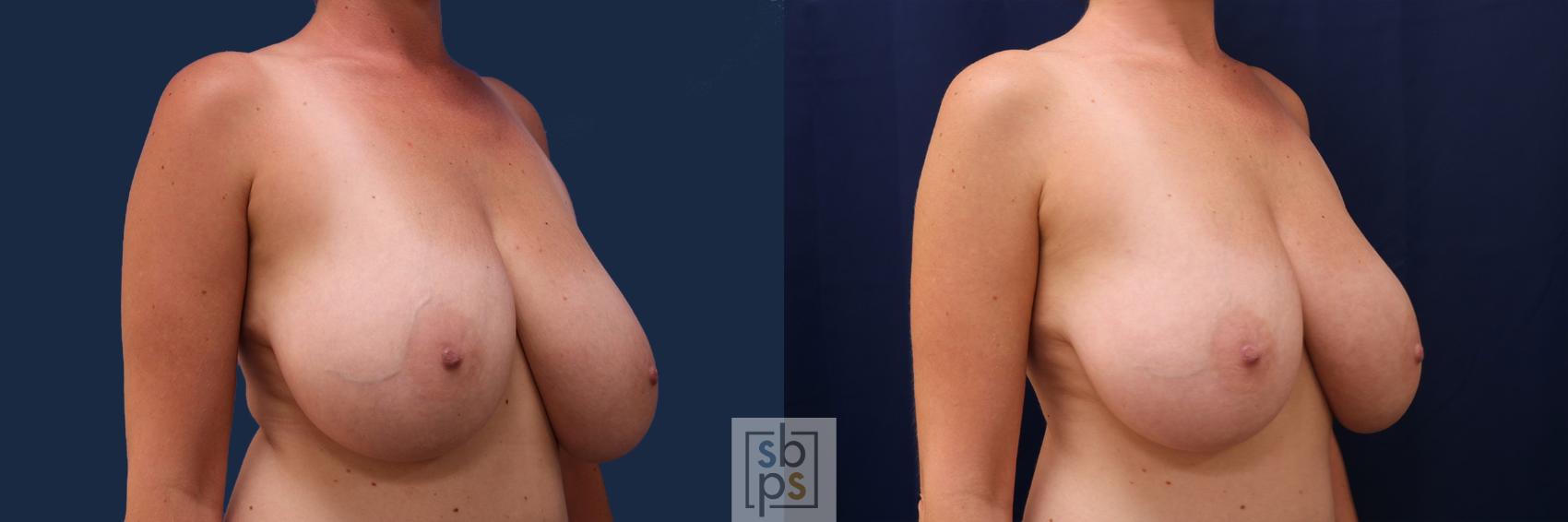 Before & After Breast Reduction Case 499 Right Oblique View in Torrance & Los Angeles, CA, CA
