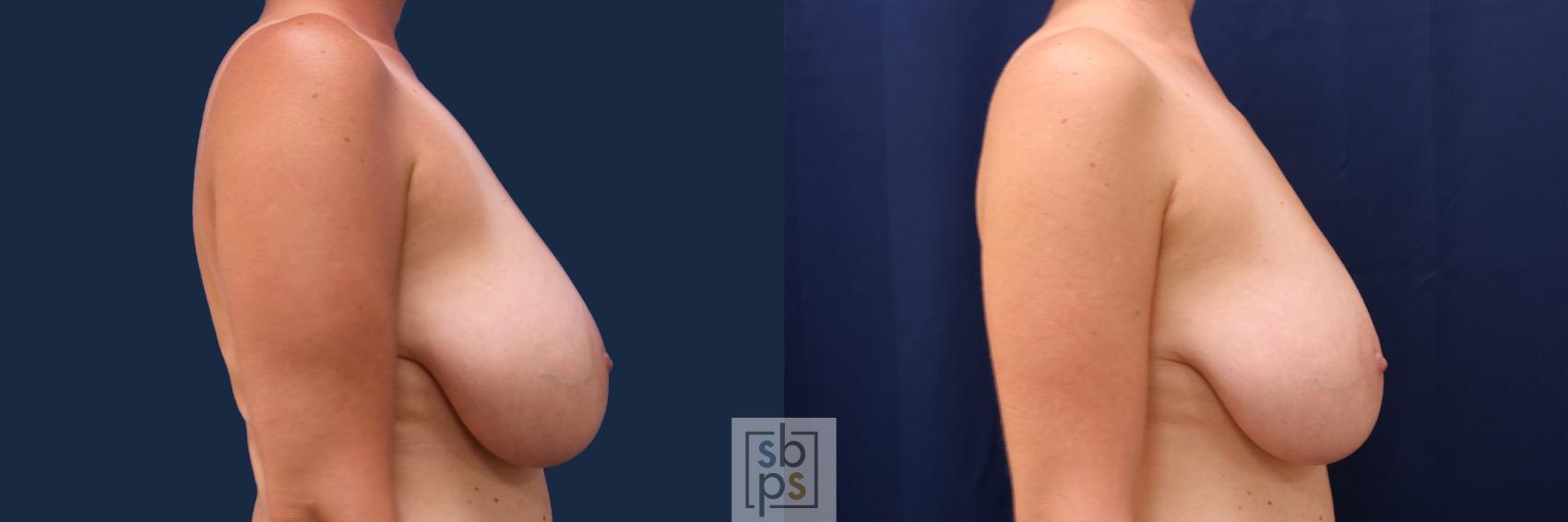 Before & After Breast Reduction Case 499 Right Side View in Torrance & Los Angeles, CA, CA
