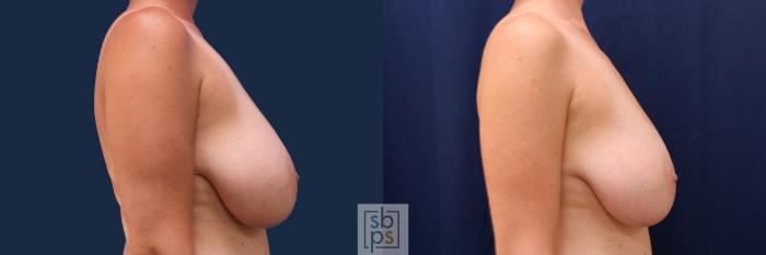 Before & After Breast Reduction Case 499 Right Side View in Torrance, CA