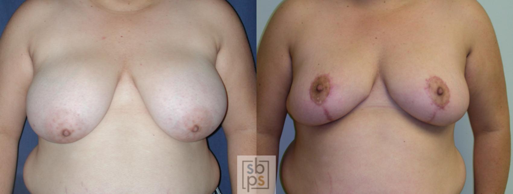Before & After Breast Reduction Case 50 View #1 View in Torrance, CA