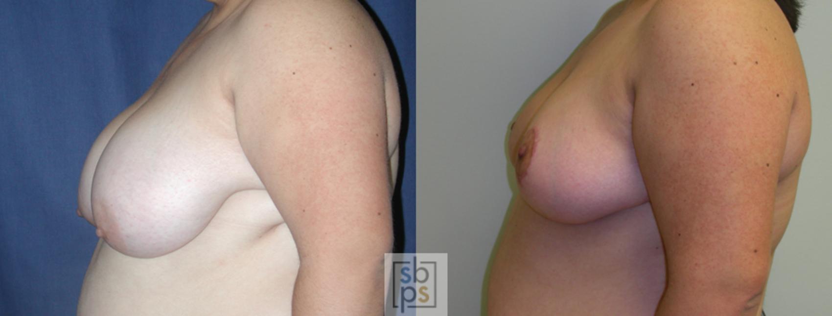 Before & After Breast Reduction Case 50 View #2 View in Torrance & Los Angeles, CA, CA