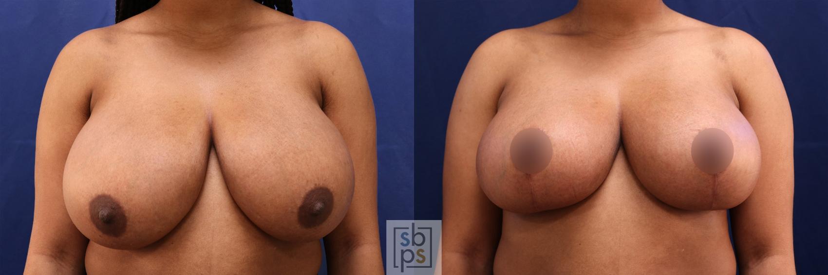 Before & After Breast Reduction Case 509 Front View in Torrance, CA