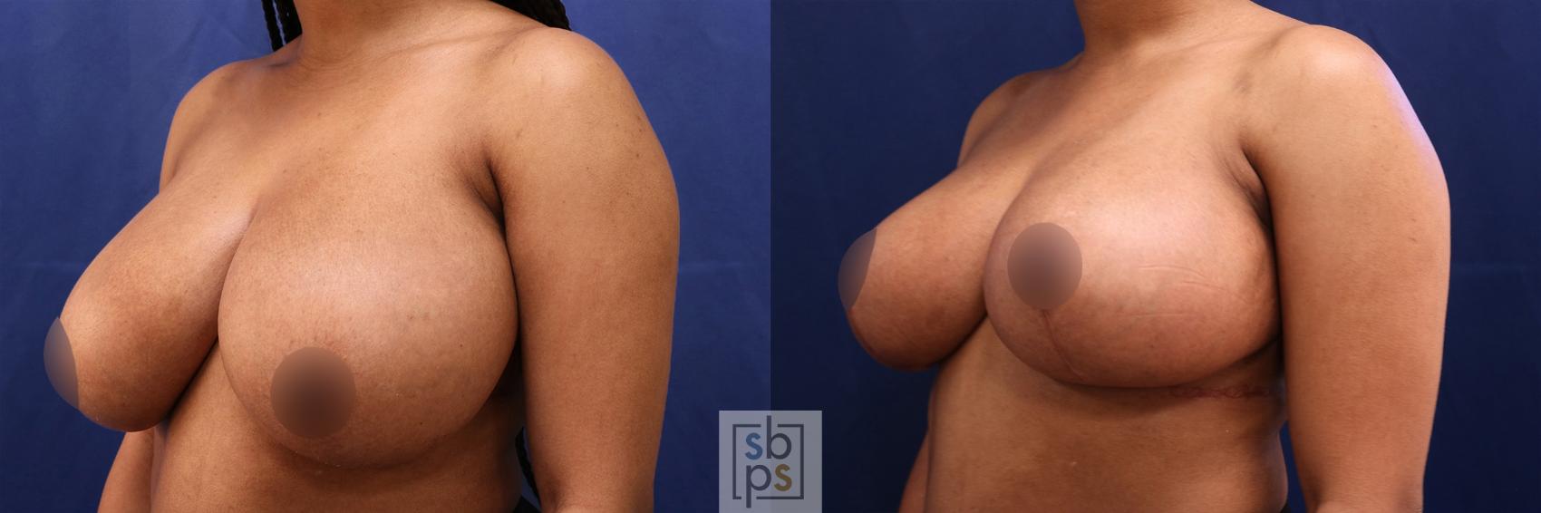 Before & After Breast Reduction Case 509 Left Oblique View in Torrance & Los Angeles, CA, CA