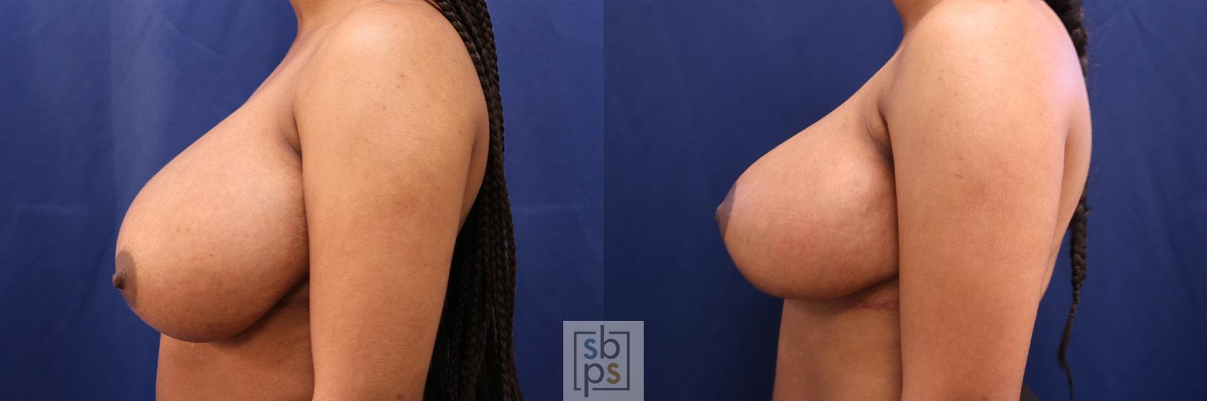 Before & After Breast Reduction Case 509 Left Side View in Torrance & Los Angeles, CA, CA