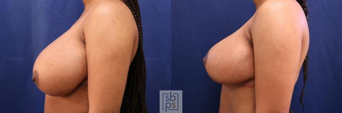 Before & After Breast Reduction Case 509 Left Side View in Torrance, CA