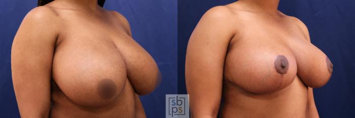 Before & After Breast Reduction Case 509 Right Oblique View in Torrance, CA
