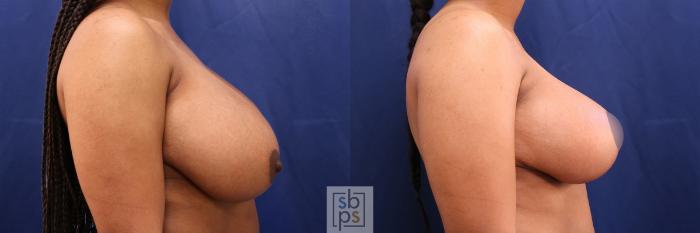 Before & After Breast Reduction Case 509 Right Side View in Torrance, CA