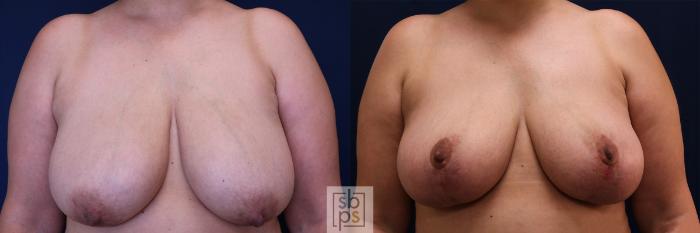 Before & After Breast Reduction Case 512 Front View in Torrance, CA