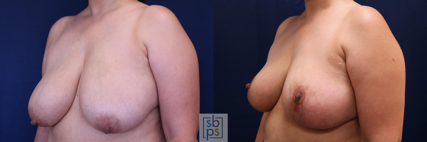 Before & After Breast Reduction Case 512 Left Oblique View in Torrance & Los Angeles, CA, CA