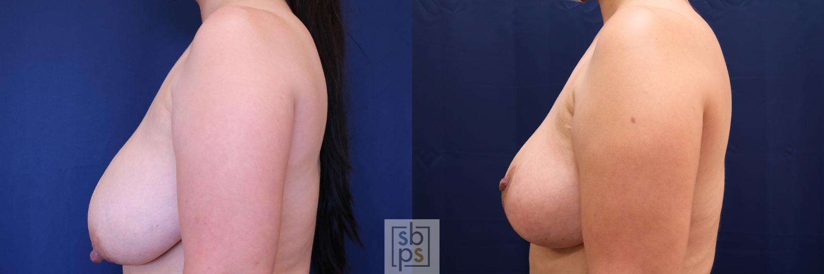 Before & After Breast Reduction Case 512 Left Side View in Torrance & Los Angeles, CA, CA