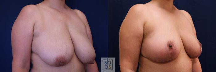 Before & After Breast Reduction Case 512 Right Oblique View in Torrance, CA