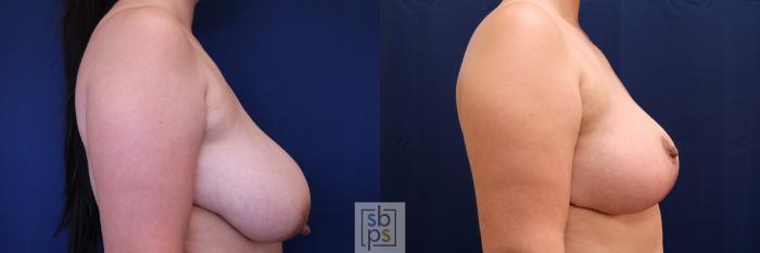 Before & After Breast Reduction Case 512 Right Side View in Torrance, CA