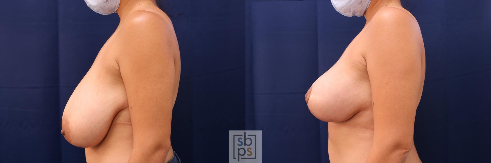 Before & After Breast Reduction Case 516 Left Side View in Torrance & Los Angeles, CA, CA