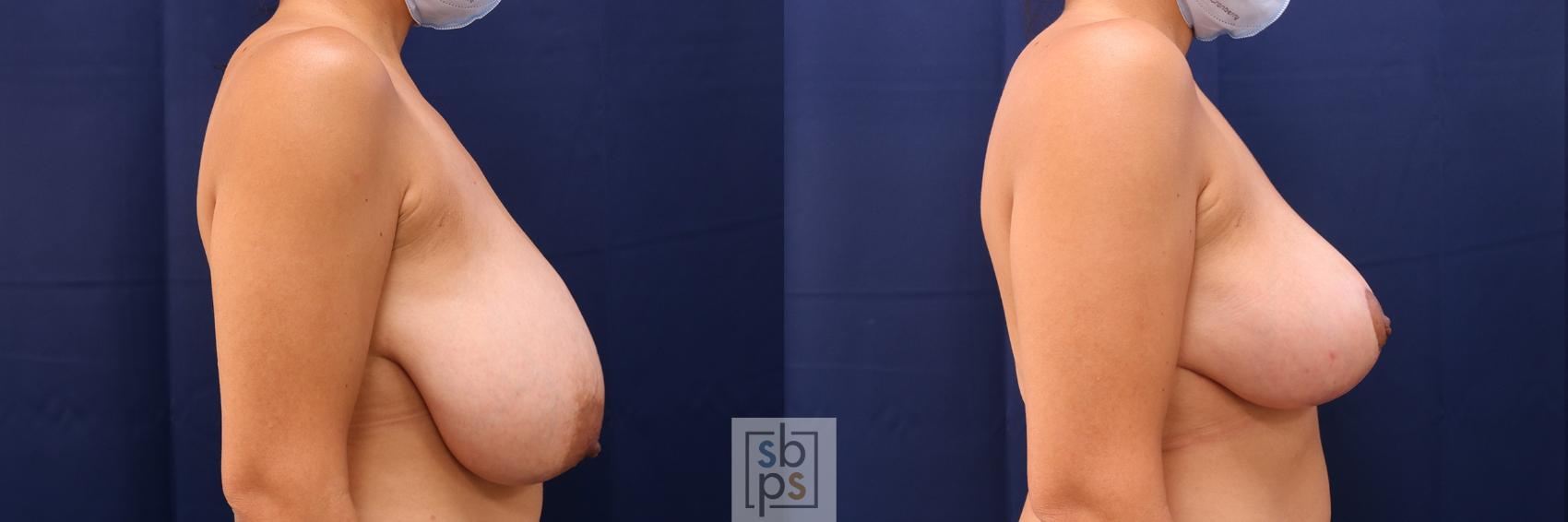 Before & After Breast Reduction Case 516 Right Side View in Torrance & Los Angeles, CA, CA