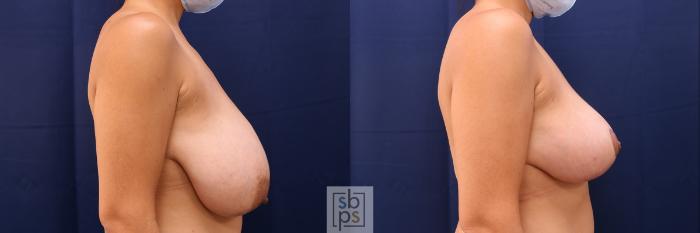Before & After Breast Reduction Case 516 Right Side View in Torrance, CA