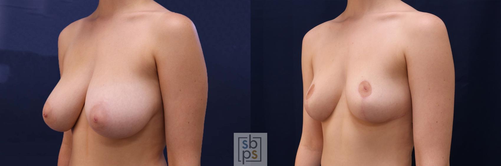 Before & After Breast Reduction Case 517 Left Oblique View in Torrance & Los Angeles, CA, CA
