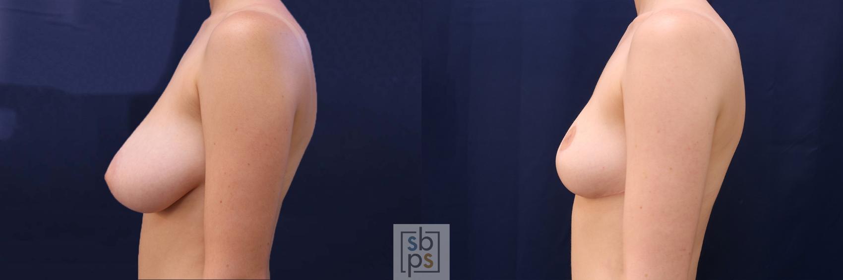 Before & After Breast Reduction Case 517 Left Side View in Torrance & Los Angeles, CA, CA