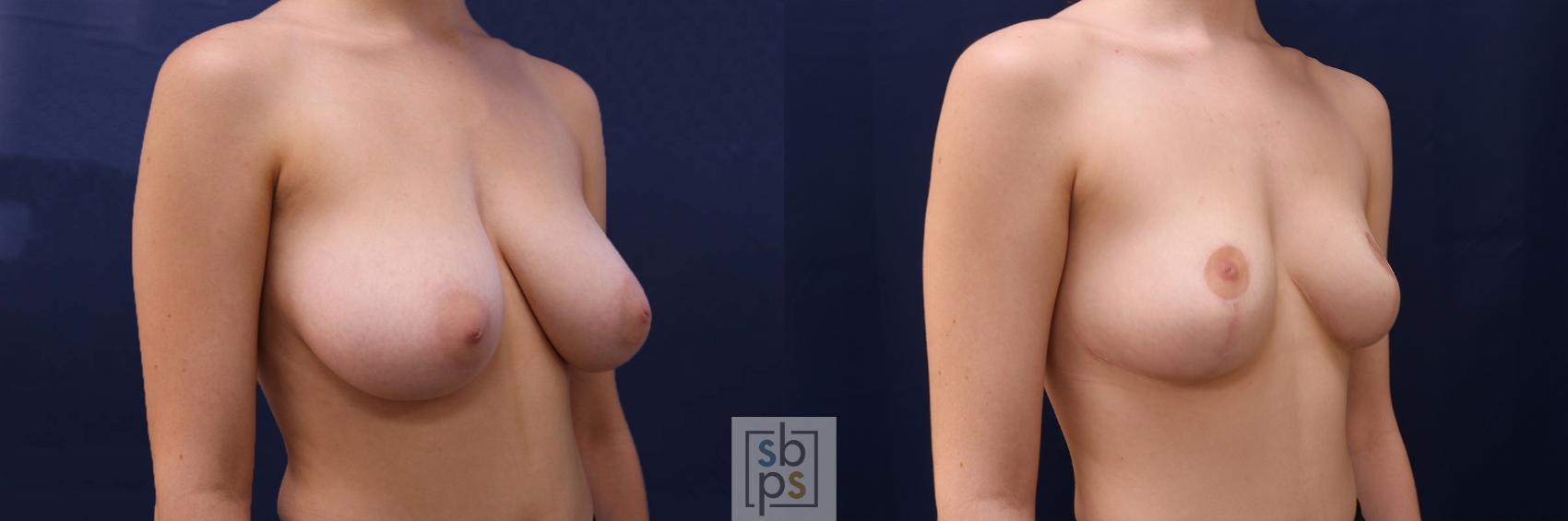 Before & After Breast Reduction Case 517 Right Oblique View in Torrance & Los Angeles, CA, CA