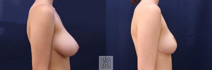 Before & After Breast Reduction Case 517 Right Side View in Torrance, CA