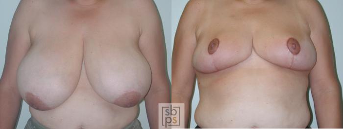 Before & After Breast Reduction Case 52 View #1 View in Torrance, CA