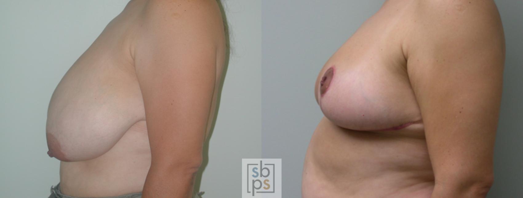 Before & After Breast Reduction Case 52 View #2 View in Torrance & Los Angeles, CA, CA